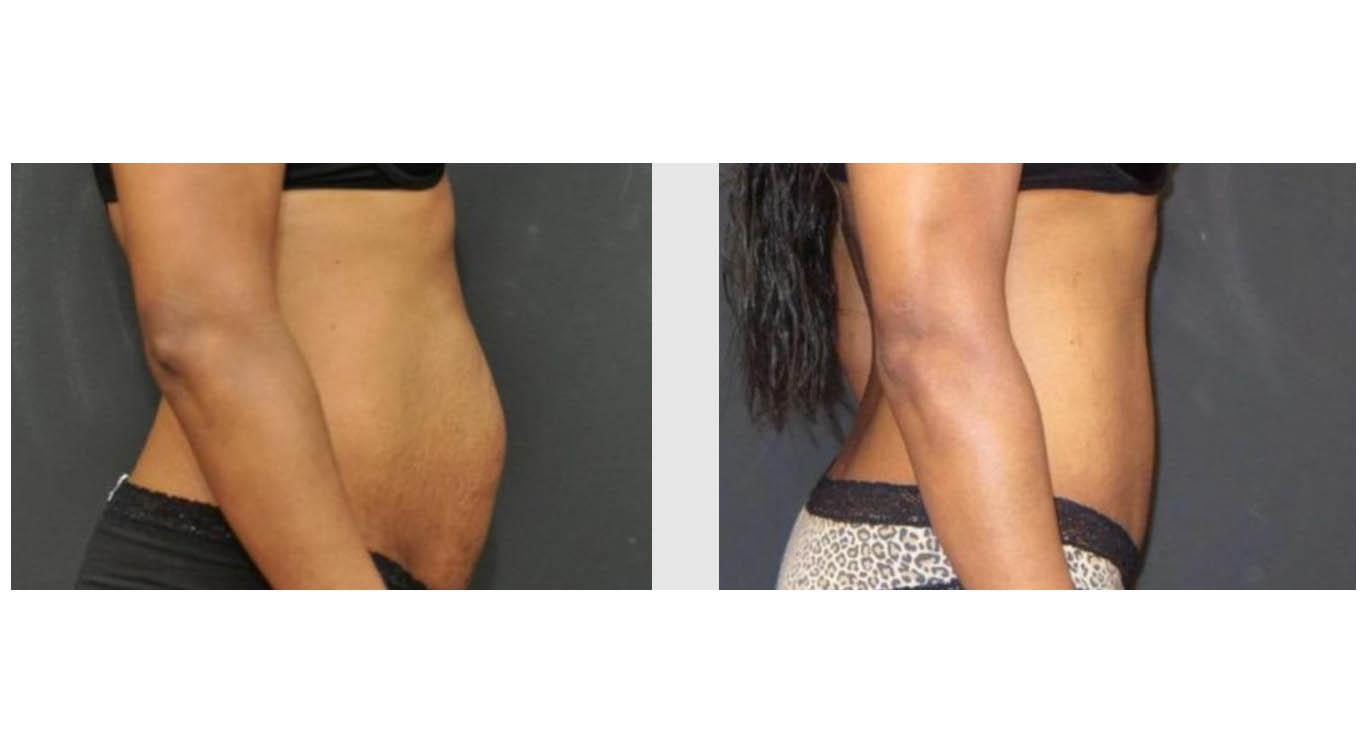 A Before and After photo of a Tummy Tuck Plastic Surgery by Dr. Craig Jonov in Seattle and Tacoma