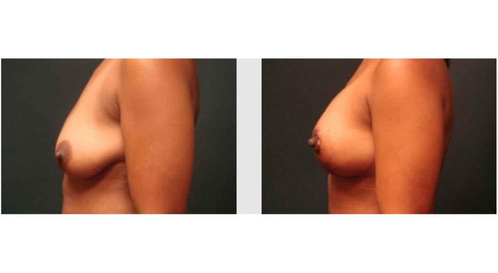 A Before and After photo of a Breast Lift Plastic Surgery by Dr. Craig Jonov in Seattle and Tacoma