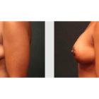 A Before and After photo of a Breast Lift Plastic Surgery by Dr. Craig Jonov in Seattle and Tacoma