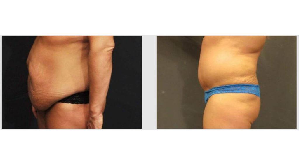A Before and After photo of a Liposuction Plastic Surgery by Dr. Craig Jonov in Seattle and Tacoma