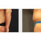 A Before and After photo of a Liposuction Plastic Surgery by Dr. Craig Jonov in Seattle and Tacoma