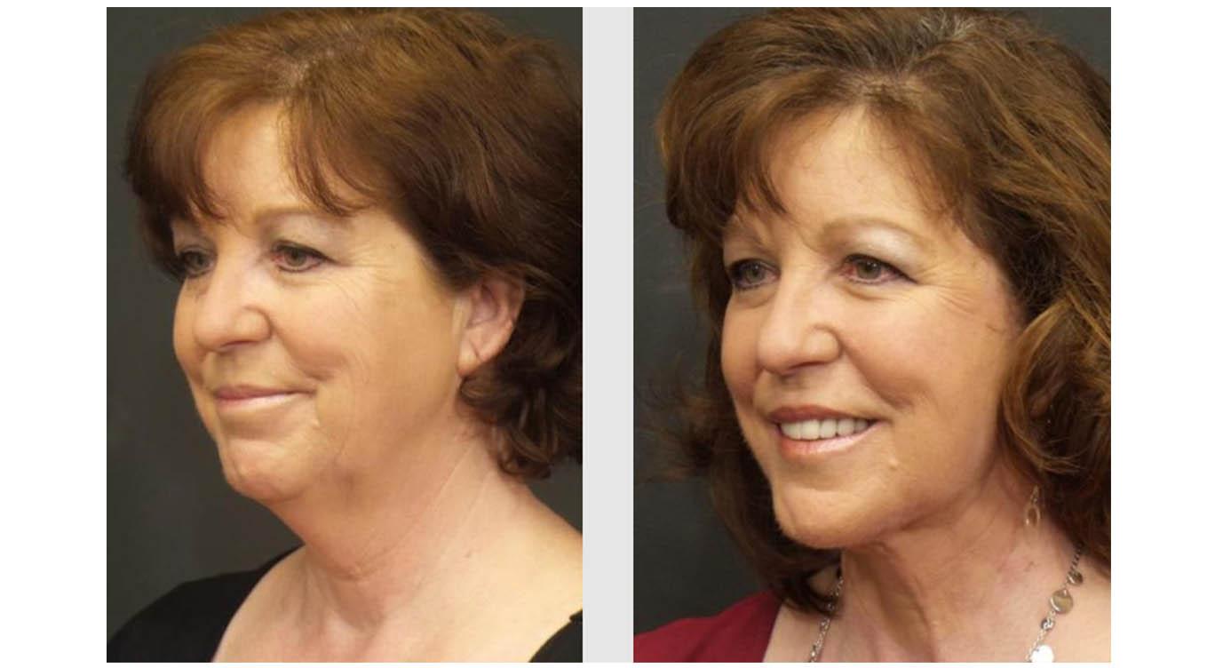 A Before and After photo of a SwiftLift Plastic Surgery by Dr. Craig Jonov in Seattle and Tacoma
