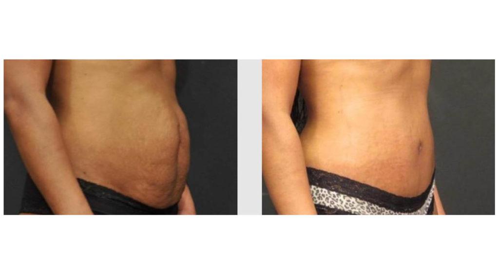 A Before and After photo of a Tummy Tuck Plastic Surgery by Dr. Craig Jonov in Seattle and Tacoma