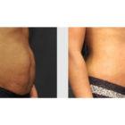 A Before and After photo of a Tummy Tuck Plastic Surgery by Dr. Craig Jonov in Seattle and Tacoma