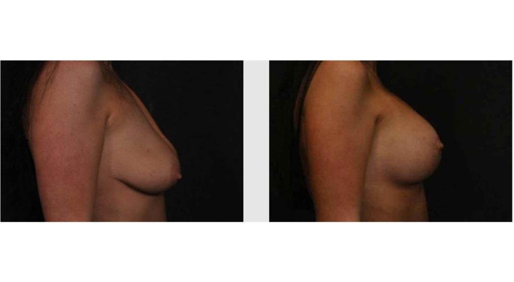 A Before and After photo of a Breast Lift Plastic Surgery by Dr. Craig Jonov in Seattle and Tacoma