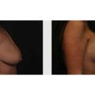 A Before and After photo of a Breast Lift Plastic Surgery by Dr. Craig Jonov in Seattle and Tacoma