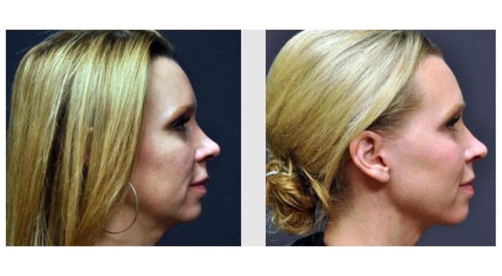 A Before and After photo of Filler injections at Seattle Plastic Surgery in Seattle and Tacoma