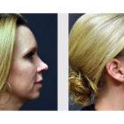 A Before and After photo of Filler injections at Seattle Plastic Surgery in Seattle and Tacoma