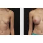 A Before and After photo of a Breast Augmentation Plastic Surgery by Dr. Craig Jonov in Seattle and Tacoma