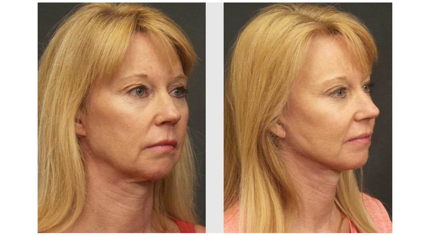 A Before and After photo of a SwiftLift Plastic Surgery by Dr. Craig Jonov in Seattle and Tacoma