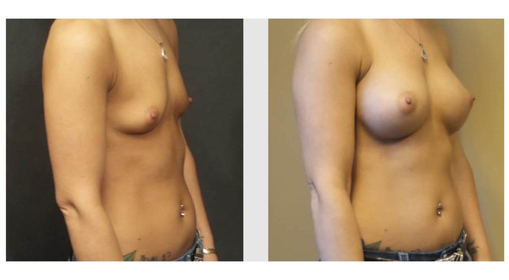 A Before and After photo of a Breast Augmentation Plastic Surgery by Dr. Craig Jonov in Seattle and Tacoma
