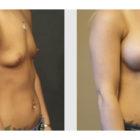 A Before and After photo of a Breast Augmentation Plastic Surgery by Dr. Craig Jonov in Seattle and Tacoma