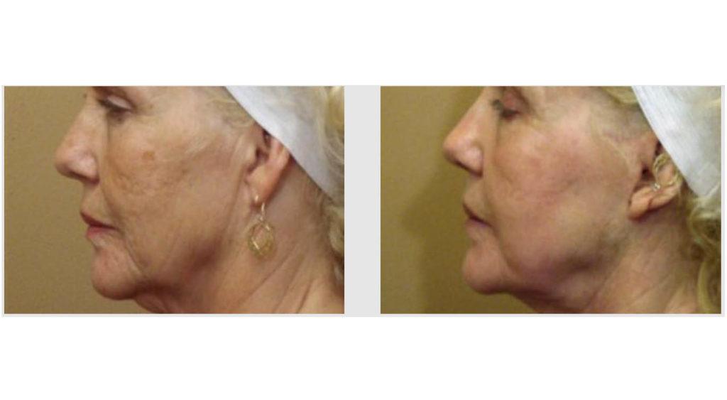 A Before and After photo of Filler injections at Seattle Plastic Surgery in Seattle and Tacoma