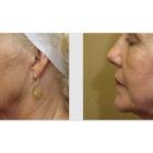 A Before and After photo of Filler injections at Seattle Plastic Surgery in Seattle and Tacoma