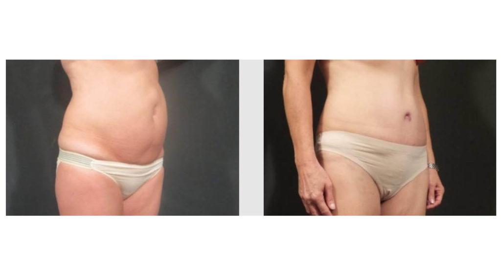 A Before and After photo of a Tummy Tuck Plastic Surgery by Dr. Craig Jonov in Seattle and Tacoma