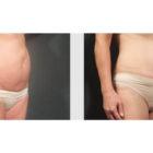 A Before and After photo of a Tummy Tuck Plastic Surgery by Dr. Craig Jonov in Seattle and Tacoma