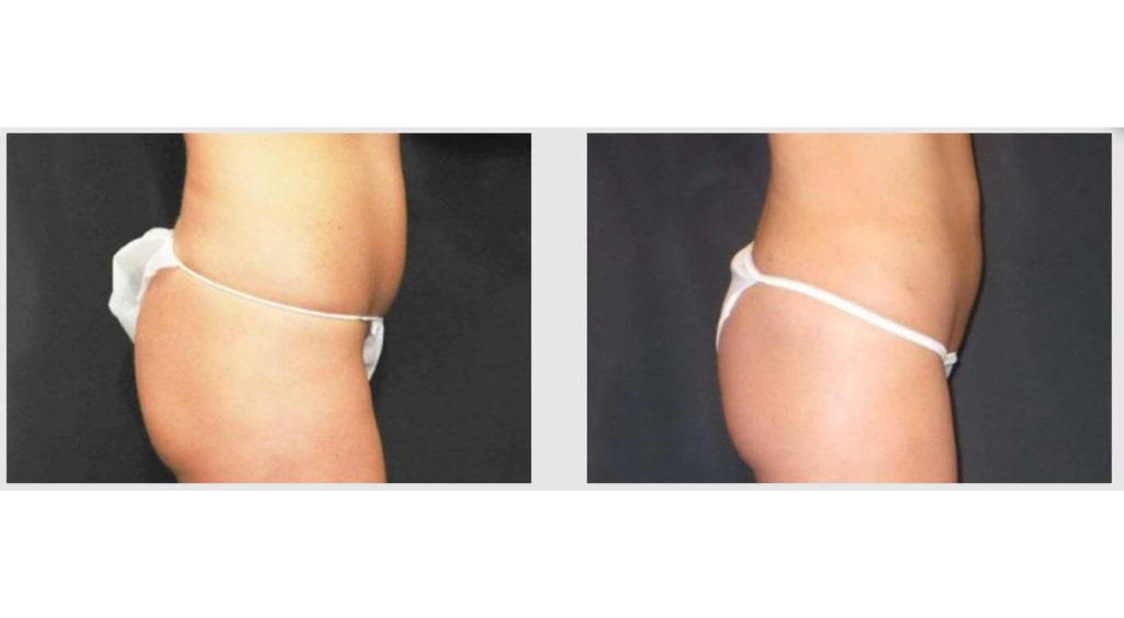 A Before and After photo of a Liposuction Plastic Surgery by Dr. Craig Jonov in Seattle and Tacoma