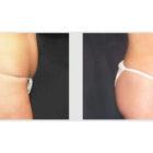 A Before and After photo of a Liposuction Plastic Surgery by Dr. Craig Jonov in Seattle and Tacoma