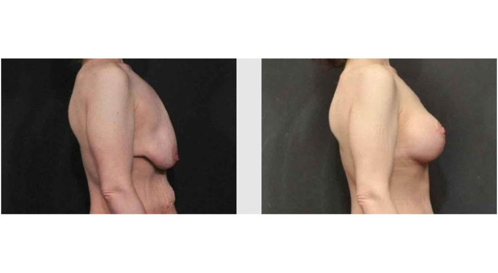 A Before and After photo of a Breast Lift Plastic Surgery by Dr. Craig Jonov in Seattle and Tacoma