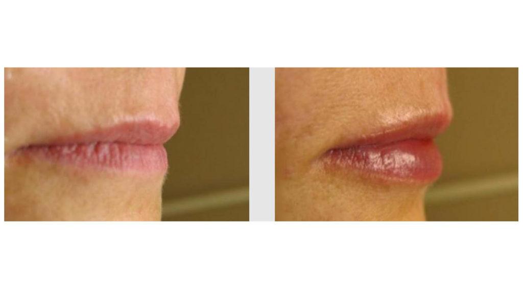 A Before and After photo of Filler injections at Seattle Plastic Surgery in Seattle and Tacoma