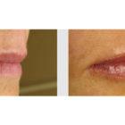 A Before and After photo of Filler injections at Seattle Plastic Surgery in Seattle and Tacoma