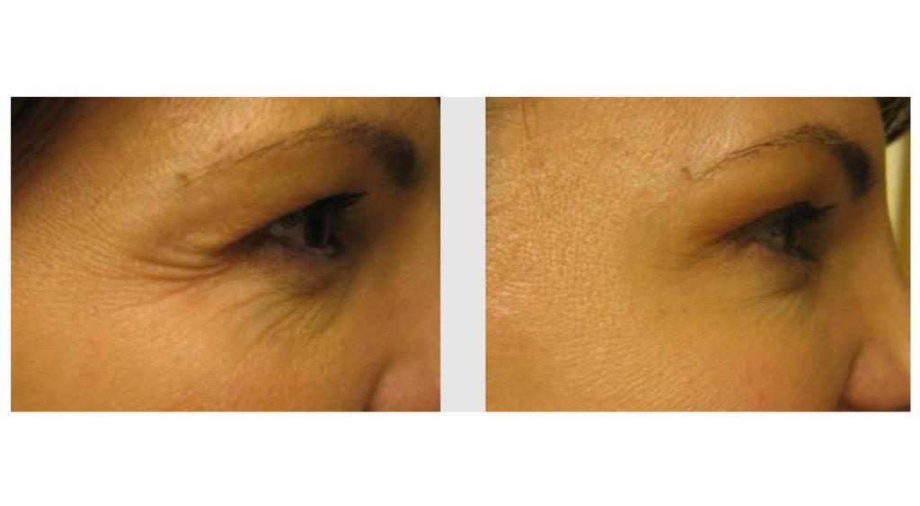 A Before and After photo of Filler injections at Seattle Plastic Surgery in Seattle and Tacoma