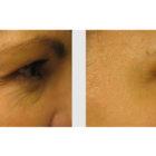 A Before and After photo of Filler injections at Seattle Plastic Surgery in Seattle and Tacoma