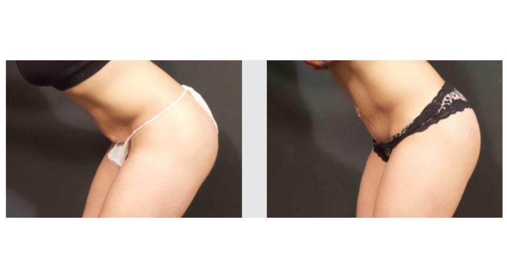 A Before and After photo of a Tummy Tuck Plastic Surgery by Dr. Craig Jonov in Seattle and Tacoma