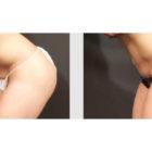 A Before and After photo of a Tummy Tuck Plastic Surgery by Dr. Craig Jonov in Seattle and Tacoma