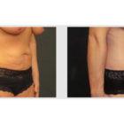 A Before and After photo of a Liposuction Plastic Surgery by Dr. Craig Jonov in Seattle and Tacoma