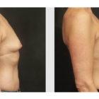 A Before and After photo of a Breast Augmentation Plastic Surgery by Dr. Craig Jonov in Seattle and Tacoma