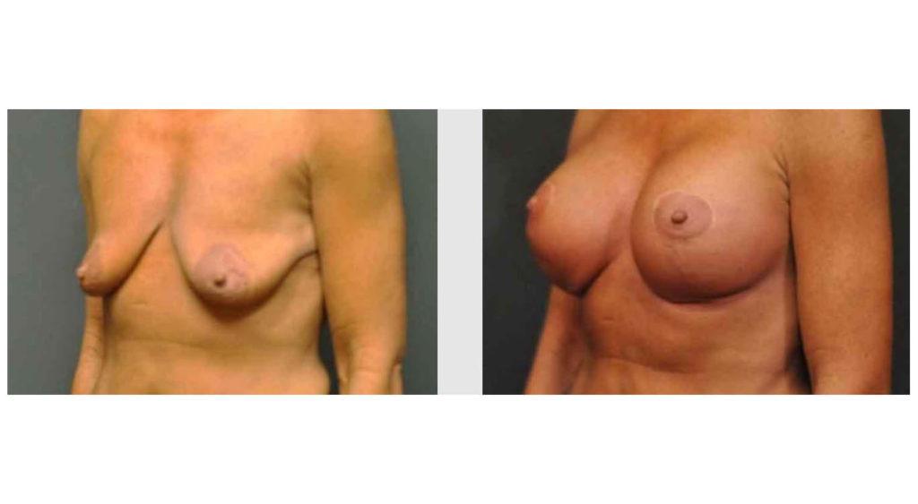 A Before and After photo of a Breast Augmentation Plastic Surgery by Dr. Craig Jonov in Seattle and Tacoma