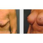 A Before and After photo of a Breast Augmentation Plastic Surgery by Dr. Craig Jonov in Seattle and Tacoma