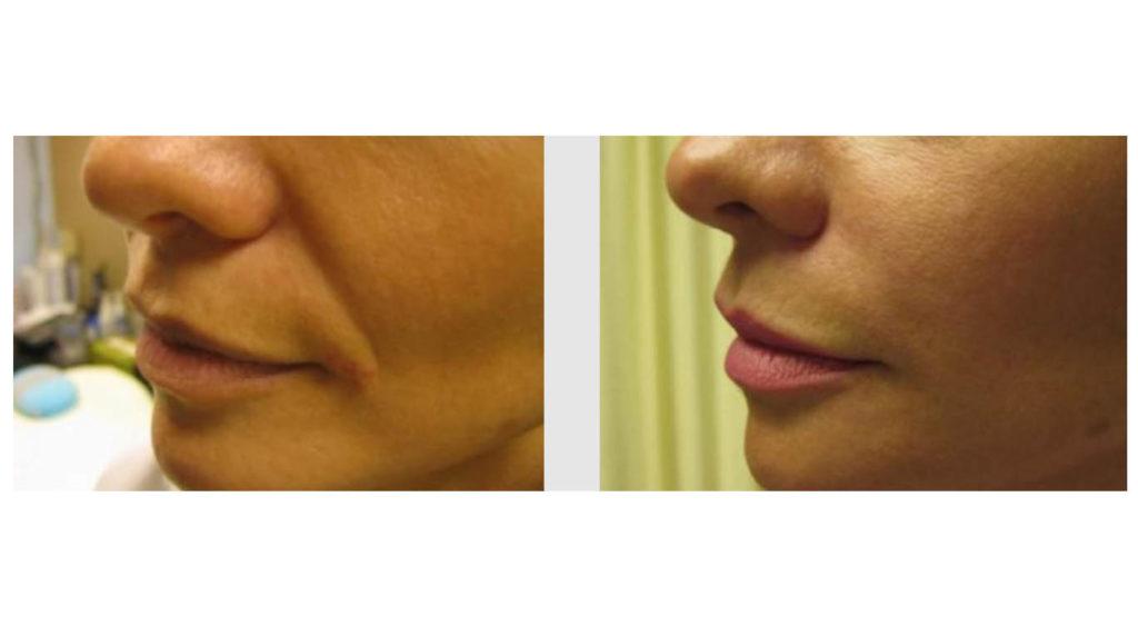 A Before and After photo of Filler injections at Seattle Plastic Surgery in Seattle and Tacoma