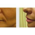 A Before and After photo of Filler injections at Seattle Plastic Surgery in Seattle and Tacoma