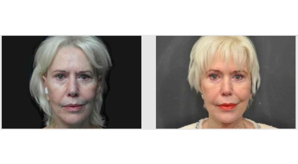A Before and After photo of Filler injections at Seattle Plastic Surgery in Seattle and Tacoma