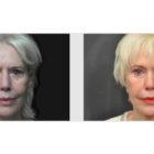 A Before and After photo of Filler injections at Seattle Plastic Surgery in Seattle and Tacoma
