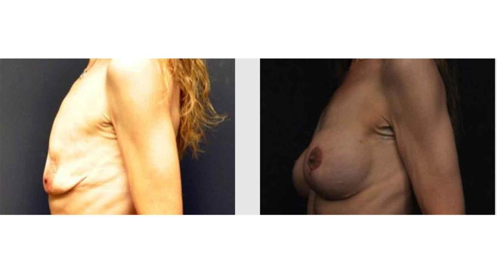 A Before and After photo of a Breast Lift Plastic Surgery by Dr. Craig Jonov in Seattle and Tacoma