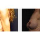 A Before and After photo of a Breast Lift Plastic Surgery by Dr. Craig Jonov in Seattle and Tacoma