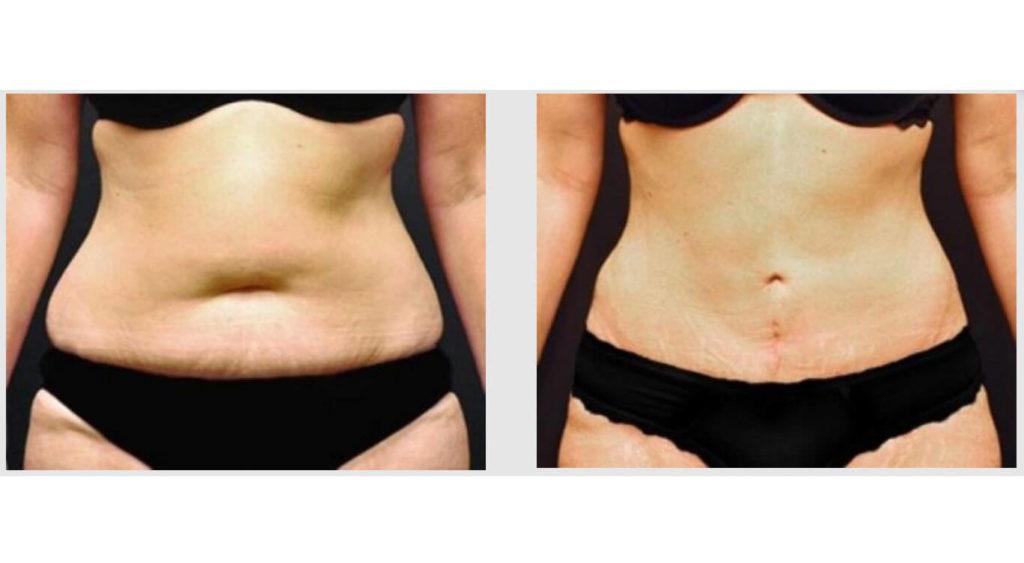 A Before and After photo of a Liposuction Plastic Surgery by Dr. Craig Jonov in Seattle and Tacoma