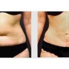 A Before and After photo of a Liposuction Plastic Surgery by Dr. Craig Jonov in Seattle and Tacoma