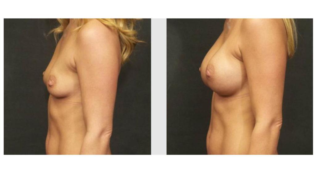 A Before and After photo of a Breast Augmentation Plastic Surgery by Dr. Craig Jonov in Seattle and Tacoma