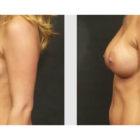 A Before and After photo of a Breast Augmentation Plastic Surgery by Dr. Craig Jonov in Seattle and Tacoma