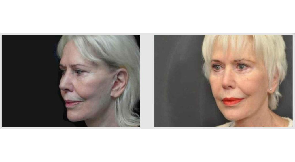 A Before and After photo of Filler injections at Seattle Plastic Surgery in Seattle and Tacoma