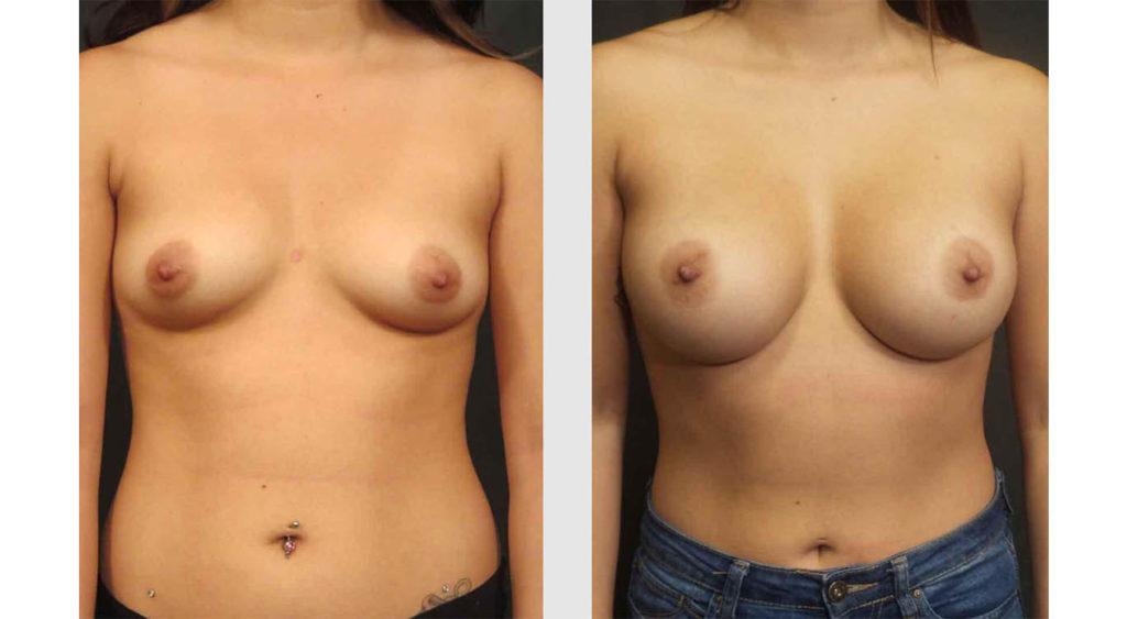 A Before and After photo of a Breast Augmentation Plastic Surgery by Dr. Craig Jonov in Seattle and Tacoma