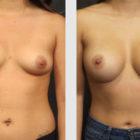 A Before and After photo of a Breast Augmentation Plastic Surgery by Dr. Craig Jonov in Seattle and Tacoma