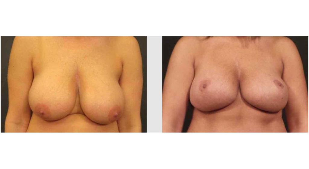 A Before and After photo of a Breast Lift Plastic Surgery by Dr. Craig Jonov in Seattle and Tacoma
