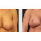 A Before and After photo of a Breast Lift Plastic Surgery by Dr. Craig Jonov in Seattle and Tacoma