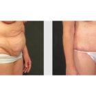 A Before and After photo of a Tummy Tuck Plastic Surgery by Dr. Craig Jonov in Seattle and Tacoma