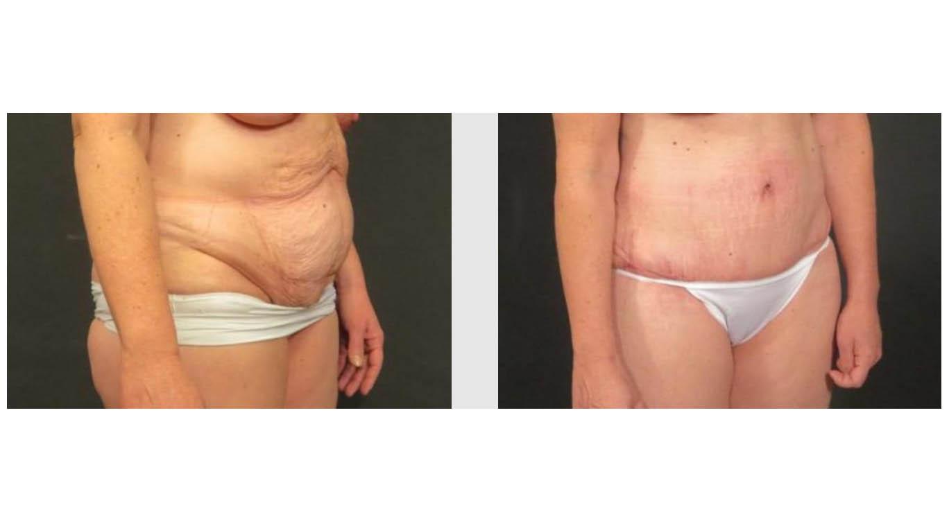 A Before and After photo of a Tummy Tuck Plastic Surgery by Dr. Craig Jonov in Seattle and Tacoma